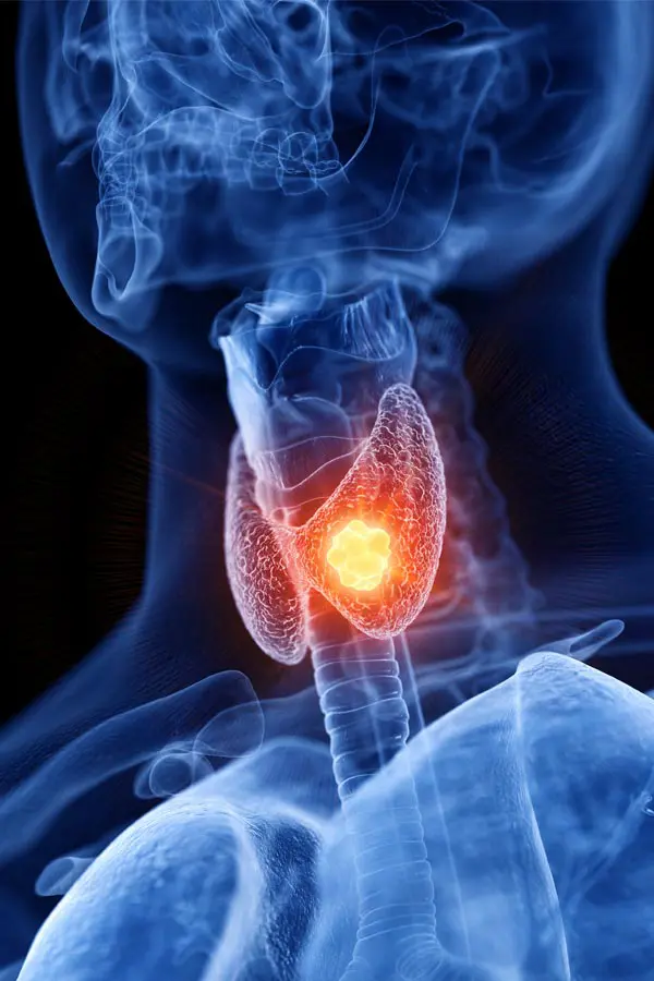 Ottawa-Thyroid-Treatment Ottawa Thyroid Treatment